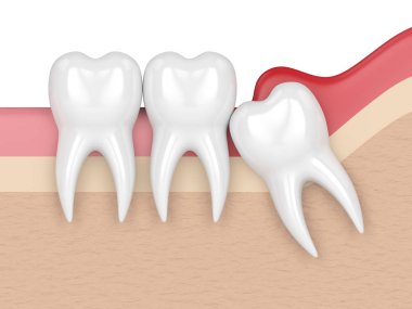 bilgelik mesial impaksiyon pericoronitis ile 3D render