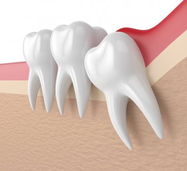 bilgelik mesial impaksiyon pericoronitis ile 3D render