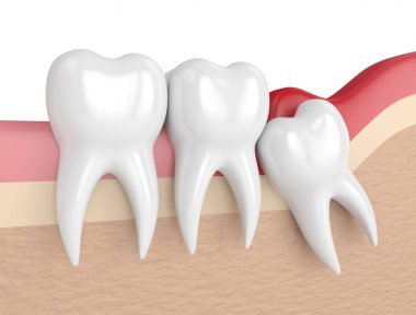 bilgelik mesial impaksiyon pericoronitis ile 3D render