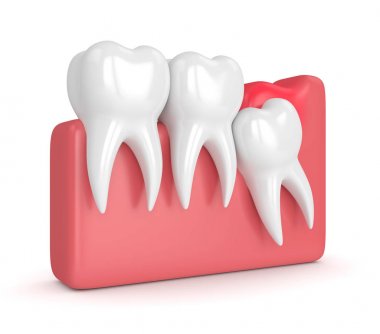 3d render of  wisdom mesial impaction with pericoronitis clipart