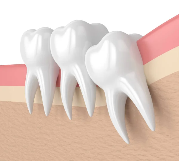 Renderização 3d de dentes com apinhamento sabedoria — Fotografia de Stock