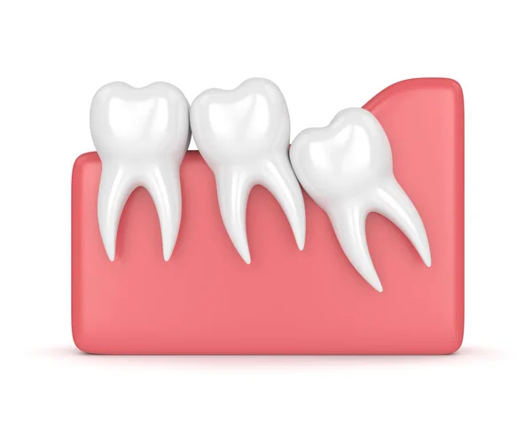 3d render of teeth with wisdom crowding — Stock Photo, Image