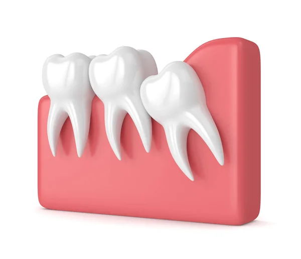 3d renderizado de dientes con hacinamiento de sabiduría — Foto de Stock