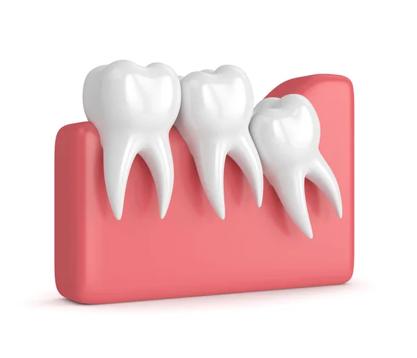 3d renderizado de dientes con hacinamiento de sabiduría — Foto de Stock