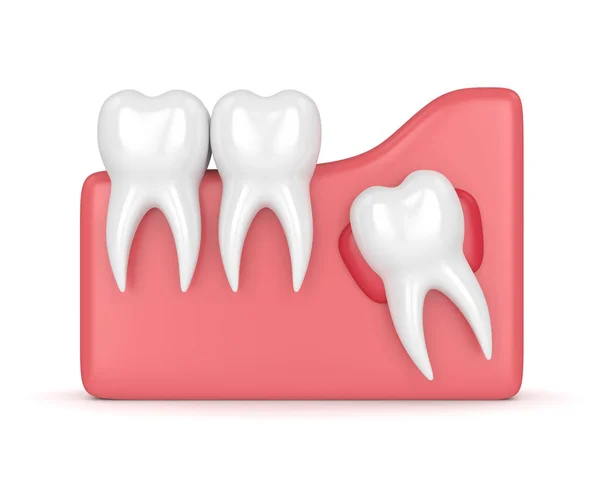 Rendering 3d dei denti con la cisti saggezza — Foto Stock