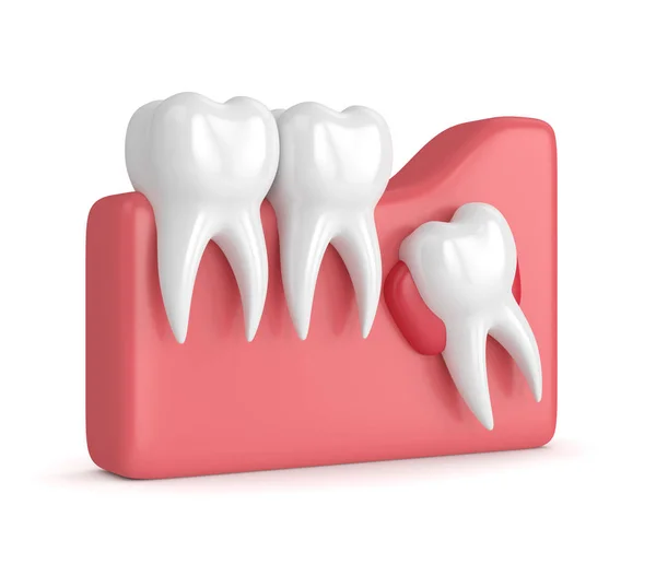 A ciszta bölcsesség fogak 3D render — Stock Fotó