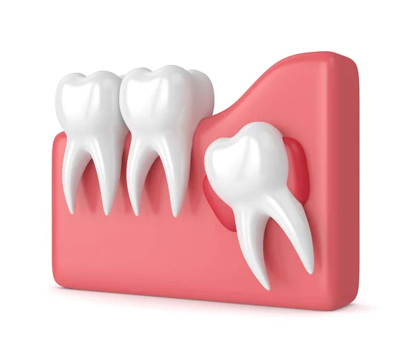 Rendering 3d dei denti con la cisti saggezza — Foto Stock