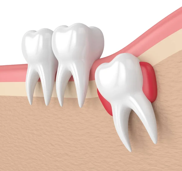 3d render of teeth with wisdom cyst — Stock Photo, Image