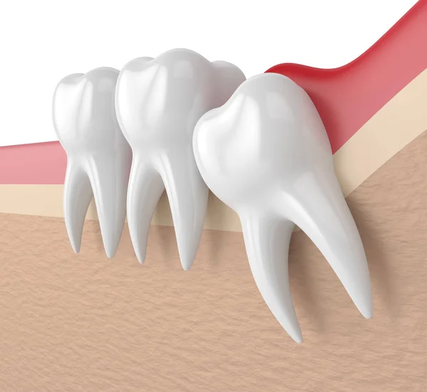 3d render of  wisdom mesial impaction with pericoronitis — Stock Photo, Image