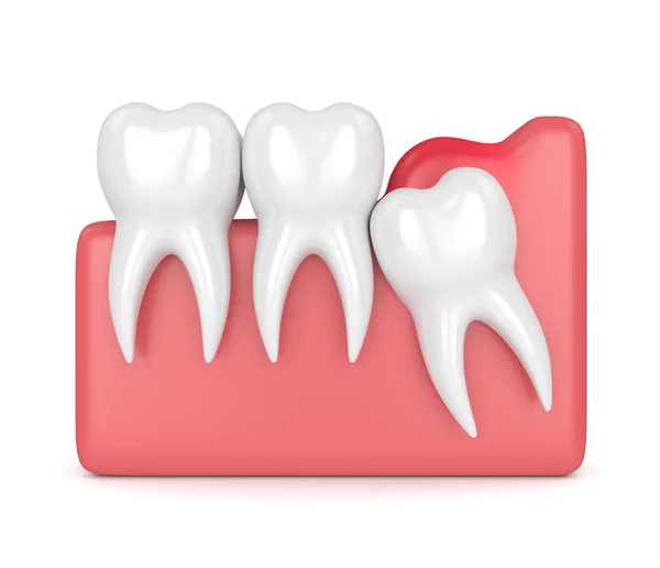 3d rendición de sabiduría impactación mesial con pericoronitis — Foto de Stock