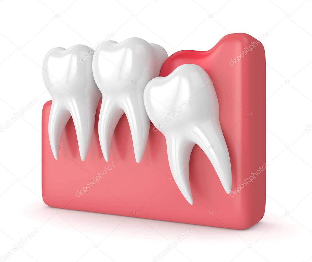 3d render of  wisdom mesial impaction with pericoronitis