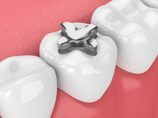 3d renderização de dentes com enchimento inlay amálgama dental — Fotografia de Stock