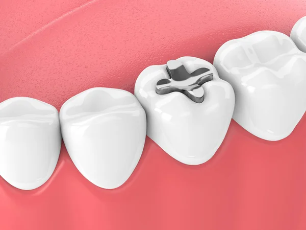 3d render de dientes con relleno de incrustaciones dentales — Foto de Stock