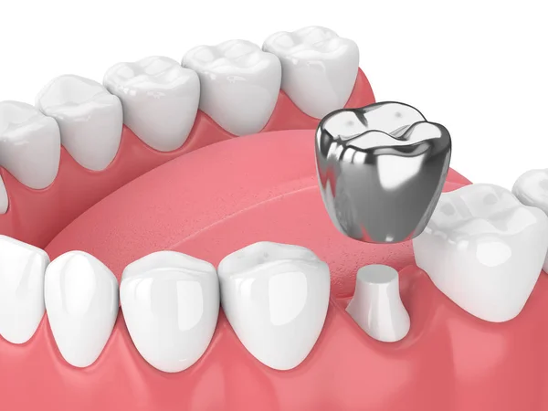 3d render of teeth with dental crown amalgam filling — Stock Photo, Image
