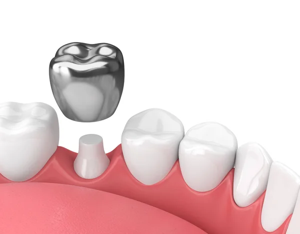 3d render of teeth with dental crown amalgam filling — Stock Photo, Image