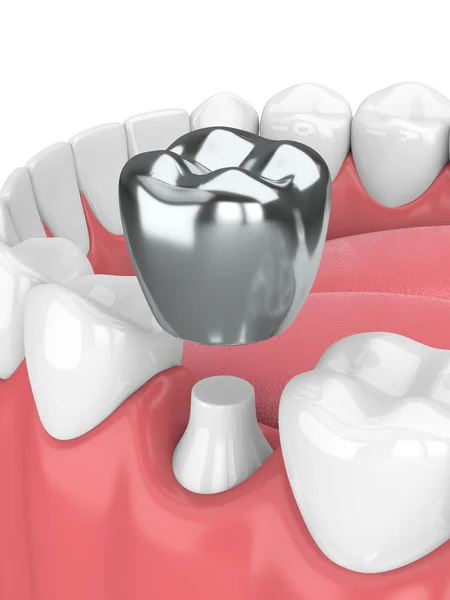 3d render of teeth with dental crown amalgam filling — Stock Photo, Image