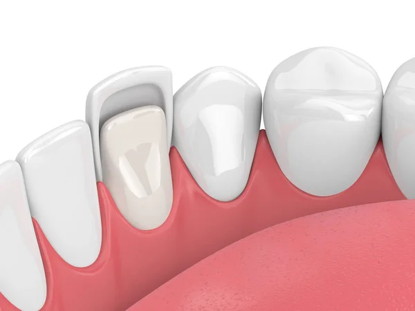 3d render of teeth with veneer — Stock Photo, Image