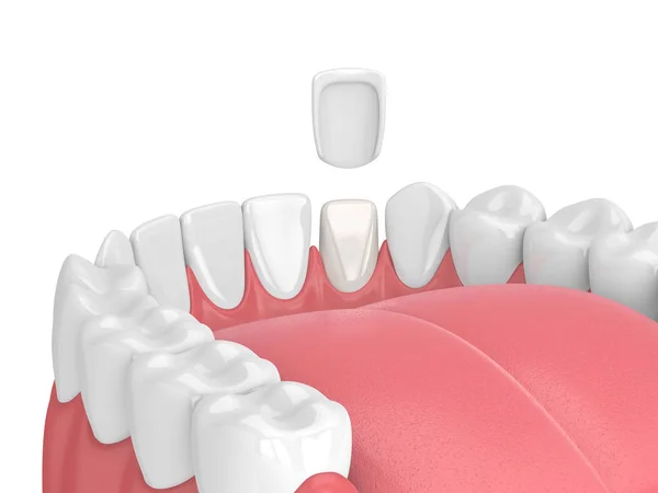3d renderizado de dientes con chapa —  Fotos de Stock