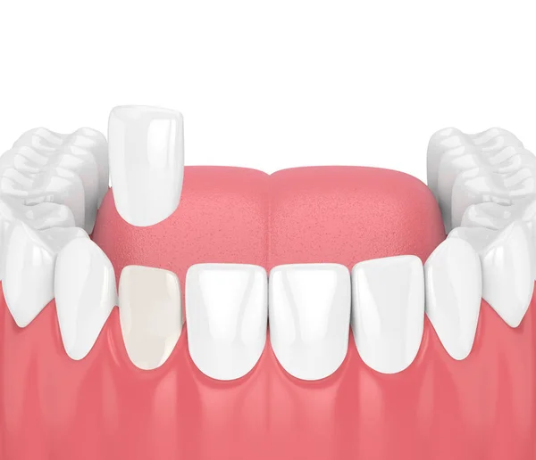 3d render of teeth with veneer — Stock Photo, Image