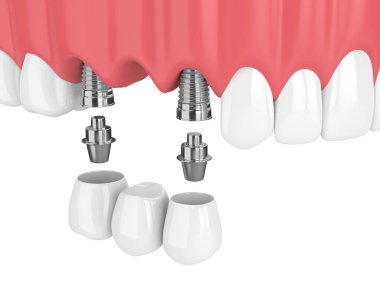 implantlar ile diş köprü üst çene beyaz arka plan üzerinde izole içinde 3D render