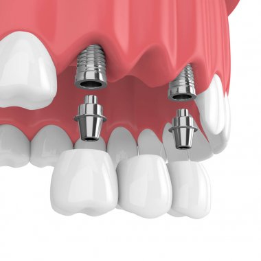 implantlar ile diş köprü üst çene beyaz arka plan üzerinde izole içinde 3D render