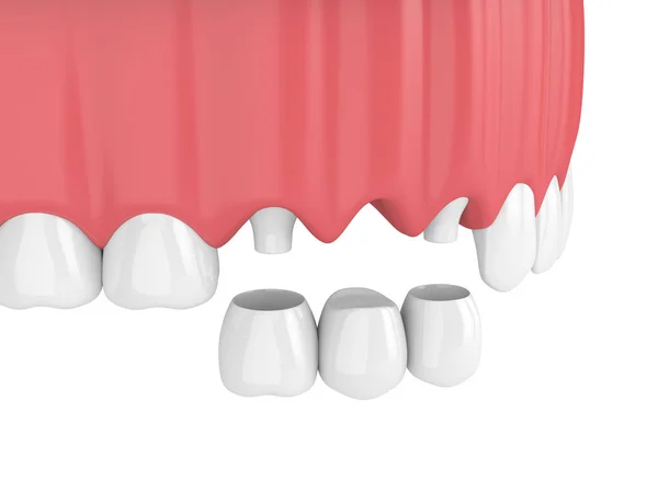 Renderização Ponte Dental Com Coroas Maxilar Superior Isolado Sobre Fundo — Fotografia de Stock