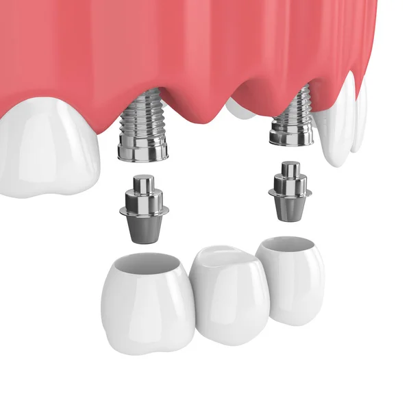 Renderizado Implantes Con Puente Dental Mandíbula Superior Aislado Sobre Fondo —  Fotos de Stock