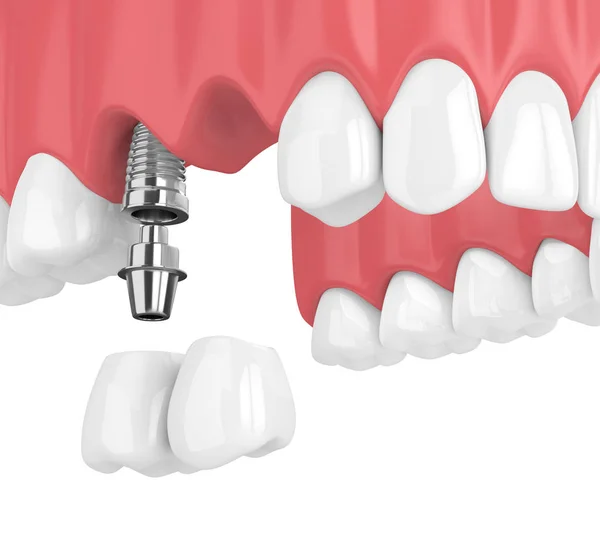 Renderizado Implantes Con Puente Voladizo Dental Mandíbula Superior Aislado Sobre —  Fotos de Stock