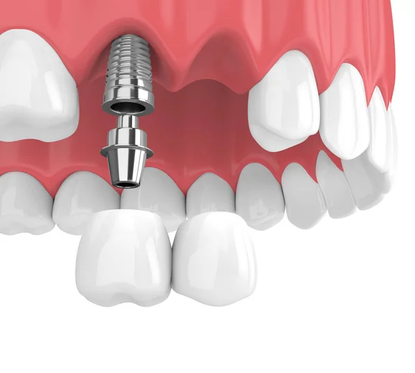 Renderização Implantes Com Ponte Cantilever Dental Mandíbula Superior Isolada Sobre — Fotografia de Stock