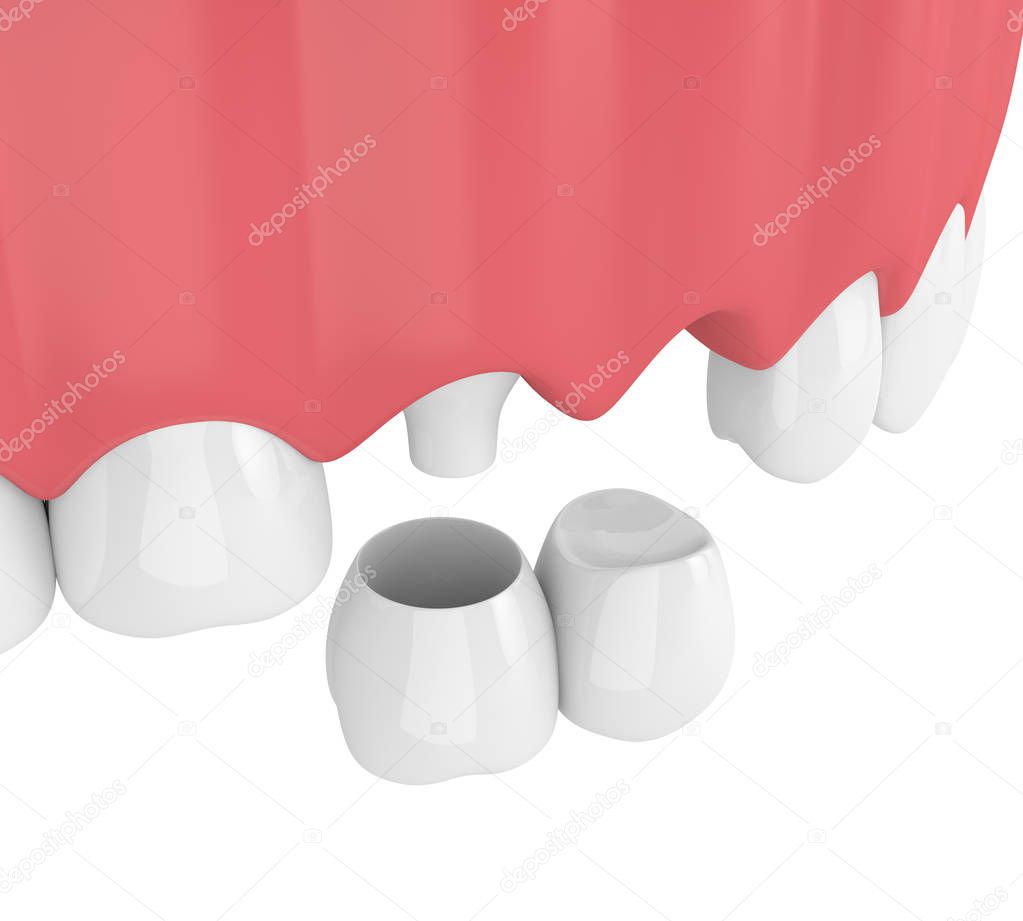 3d render of dental cantilever bridge with crowns in upper jaw isolated over white background