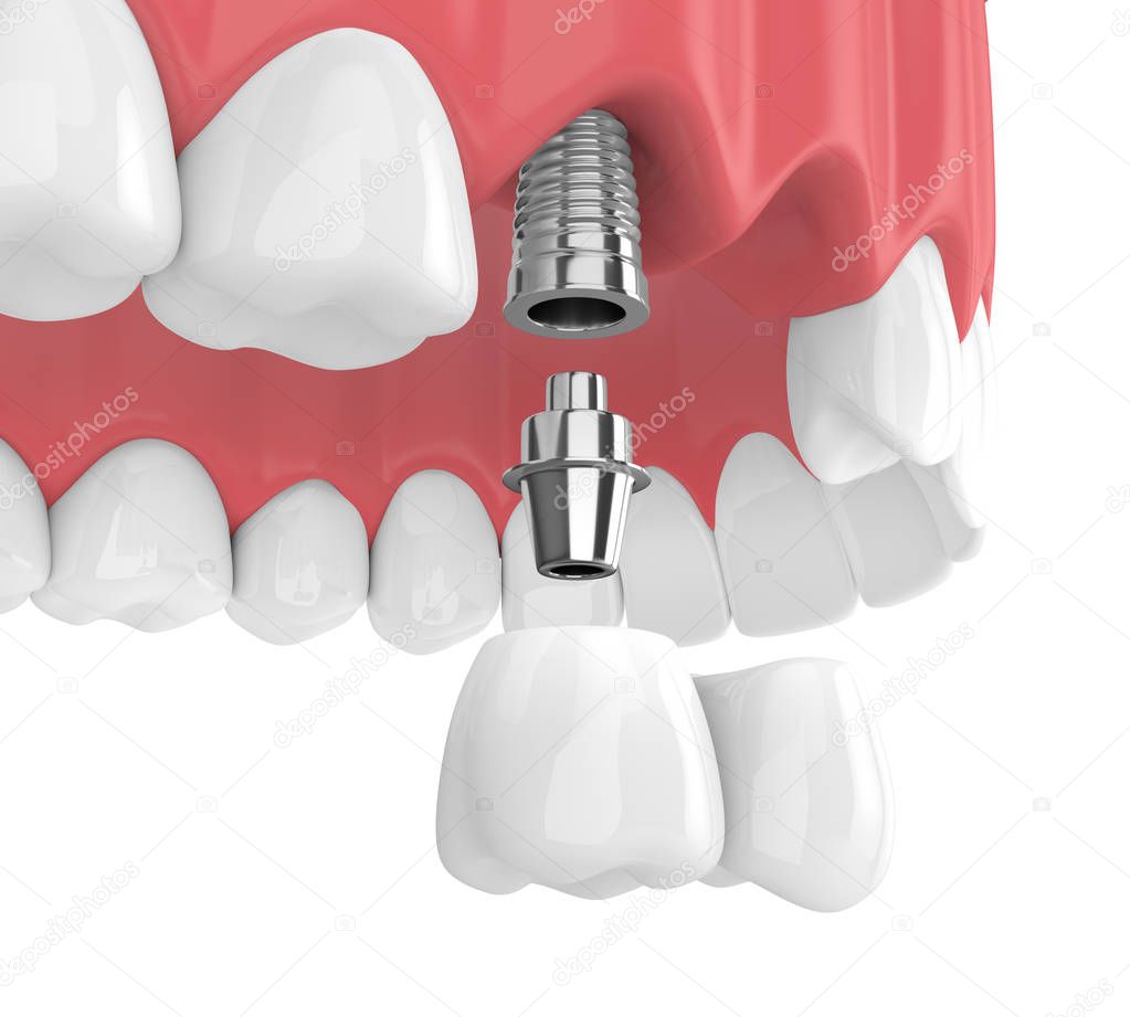 3d render of implants with dental cantilever bridge in upper jaw  isolated over white background
