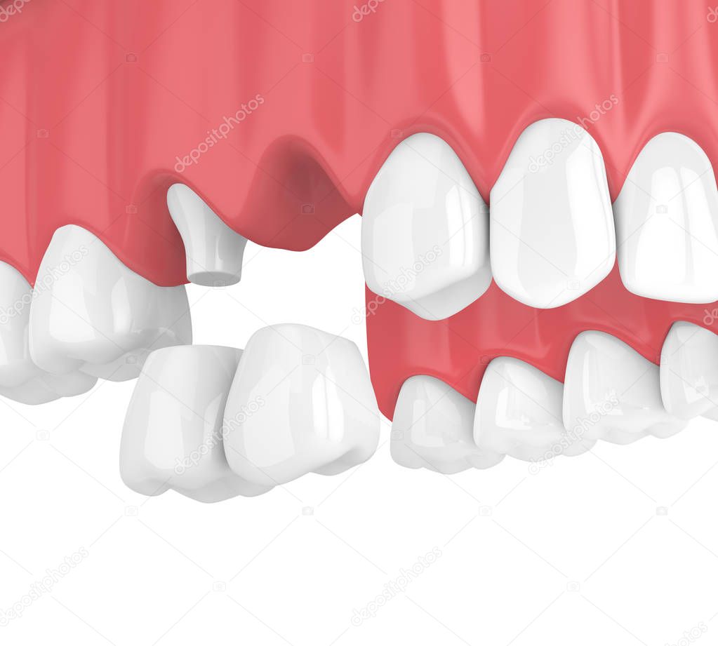 3d render of dental cantilever bridge with crowns in upper jaw isolated over white background