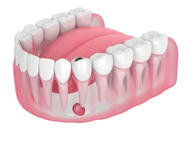 Diş boşluğu ve kist ile 3D çene oluşturma — Stok fotoğraf