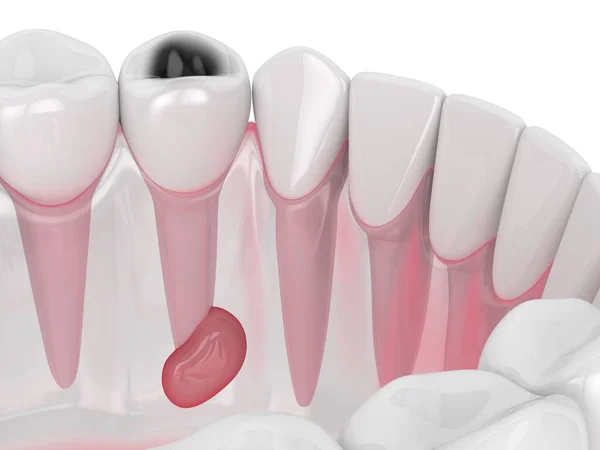 3d render of jaw with tooth cavity and cyst — Stock Photo, Image