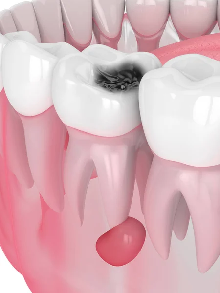 3d återgivning av käke med tand hålighet och cysta — Stockfoto