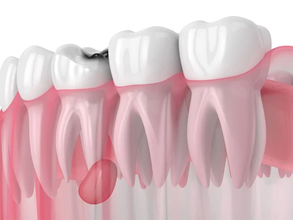 3d renderização da mandíbula com cavidade dentária e cisto — Fotografia de Stock