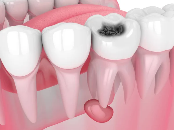 3d render of jaw with tooth cavity and cyst — Stock Photo, Image