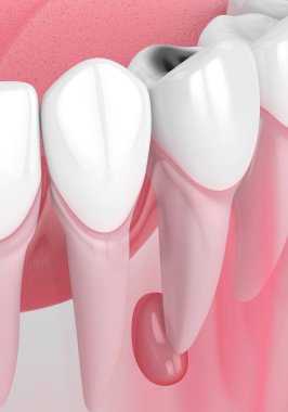 Diş boşluğu ve kist ile 3D çene oluşturma