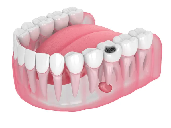 3d renderizado de mandíbula con cavidad dental y quiste — Foto de Stock