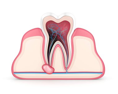 3d render of tooth in gums with cyst clipart
