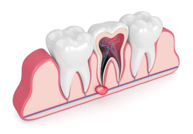 3d render of teeth in gums with cyst clipart