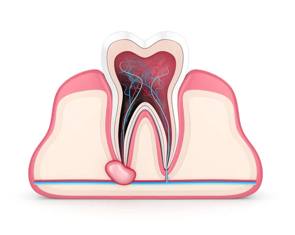 3d renderização de dente em gengivas com cisto — Fotografia de Stock