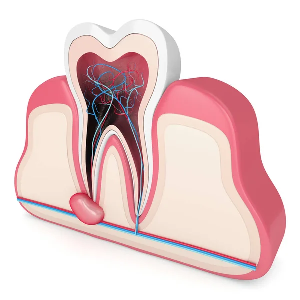 3d renderização de dente em gengivas com cisto — Fotografia de Stock