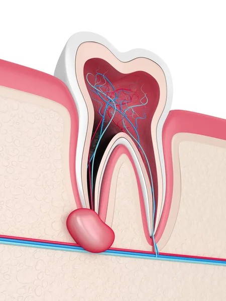낭종 이 있는 잇몸에 치아를 3D 로 렌더링하는 일 — 스톡 사진