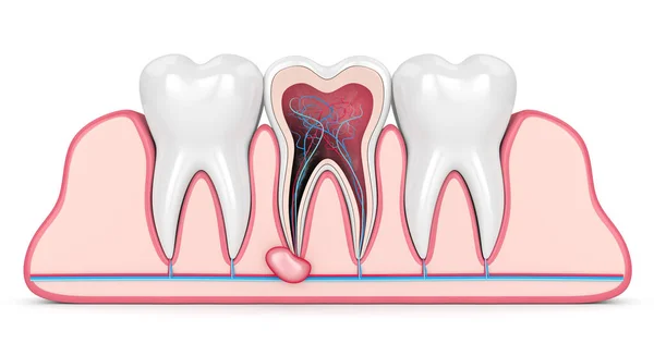 3d rendu des dents dans les gencives avec kyste — Photo