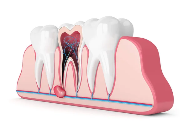 3D-återgivning av tänder i tandkött med cysta — Stockfoto