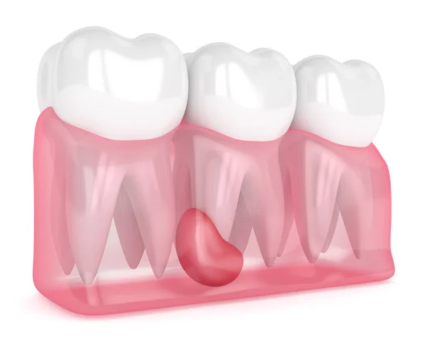 3d render of teeth in gums with cyst — Stock Photo, Image