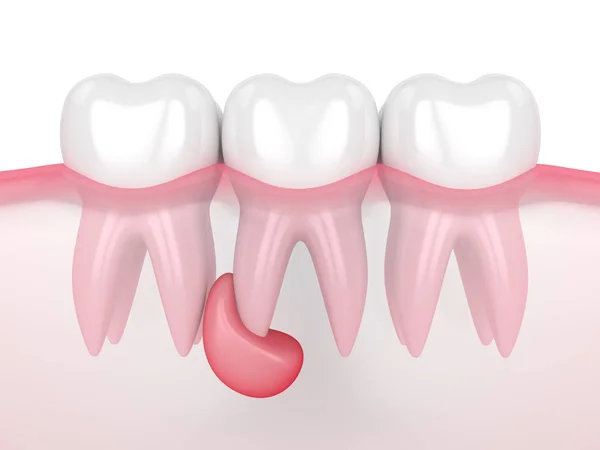 有囊肿的牙龈内的3D齿状物 — 图库照片