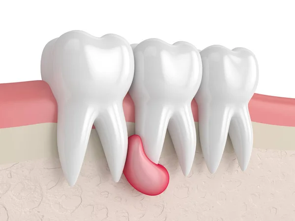 3d render of teeth in gums with cyst — Stock Photo, Image