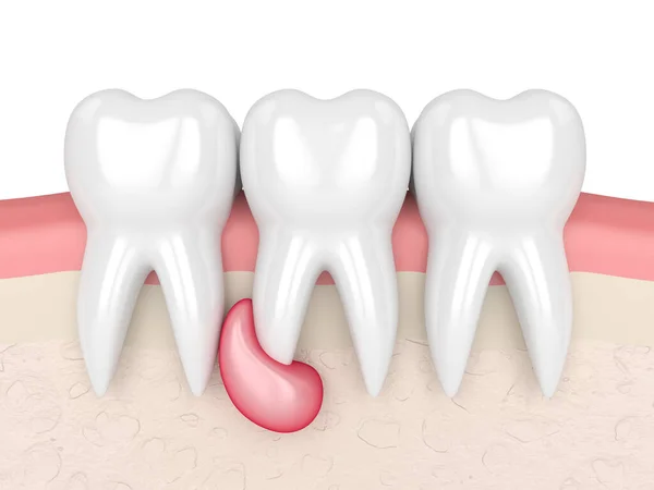 3d render of teeth in gums with cyst — Stock Photo, Image